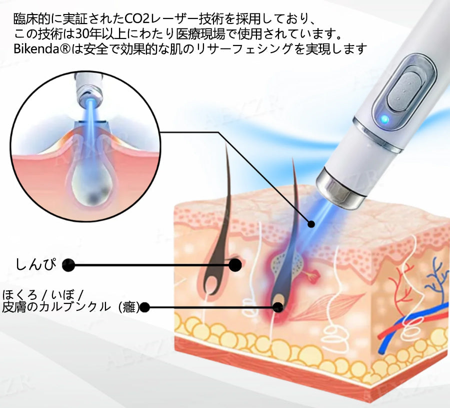 💎 Bikenda® 非侵襲型レーザーペン 自宅で安全にシミ・イボを除去できる最新アイテム！